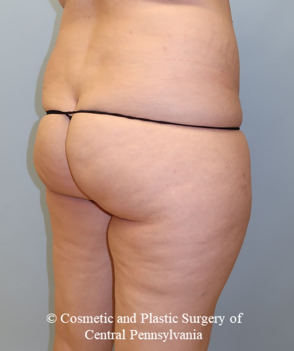 Brazilian Butt Lift Before