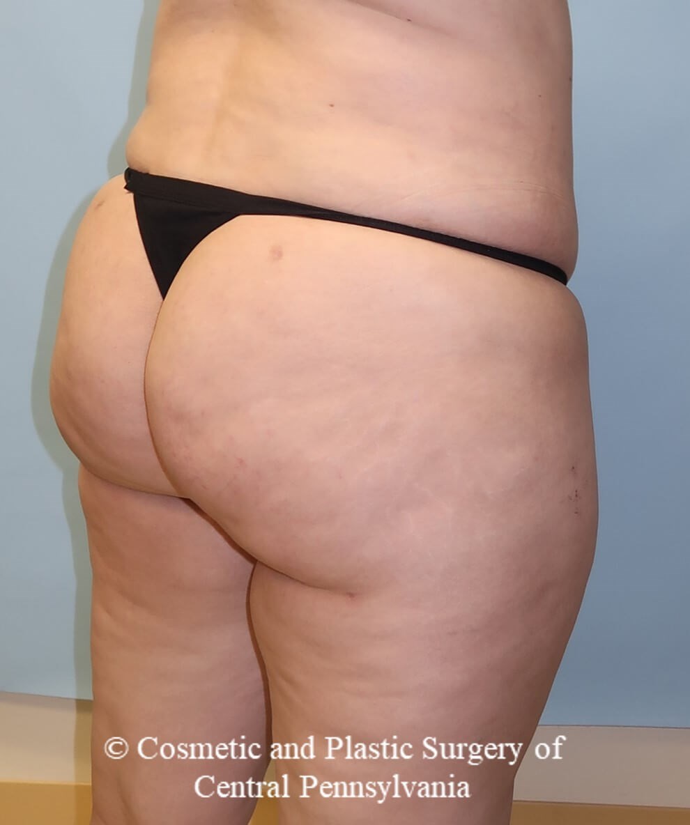 Brazilian Butt Lift After