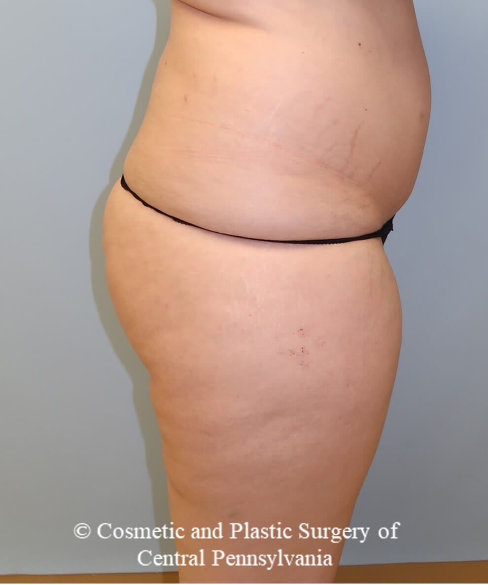 Brazilian Butt Lift Before