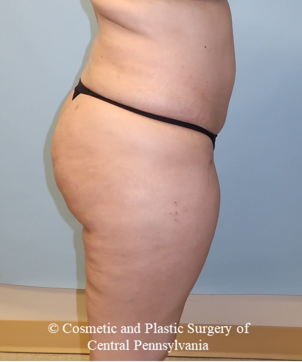 Brazilian Butt Lift After