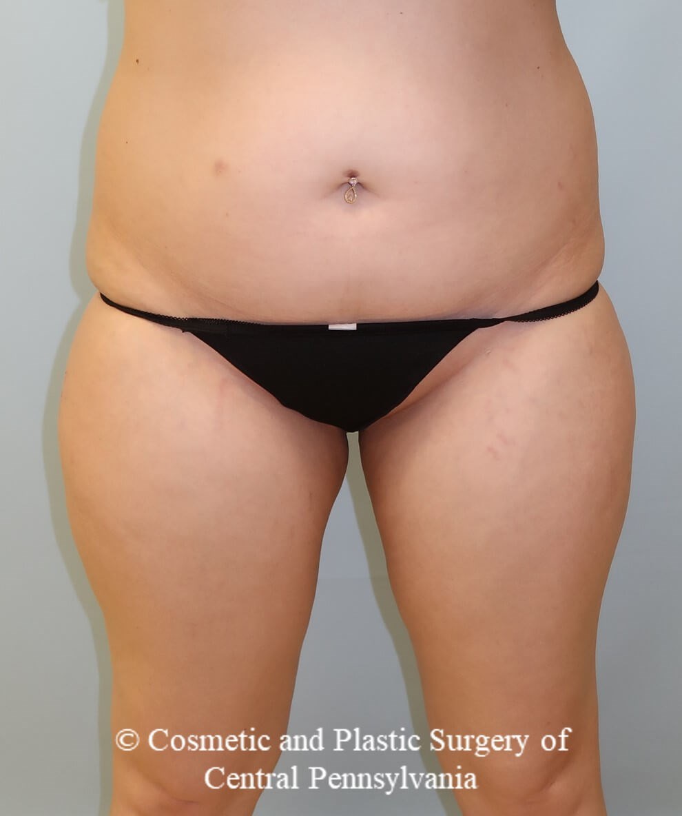 Brazilian Butt Lift Before