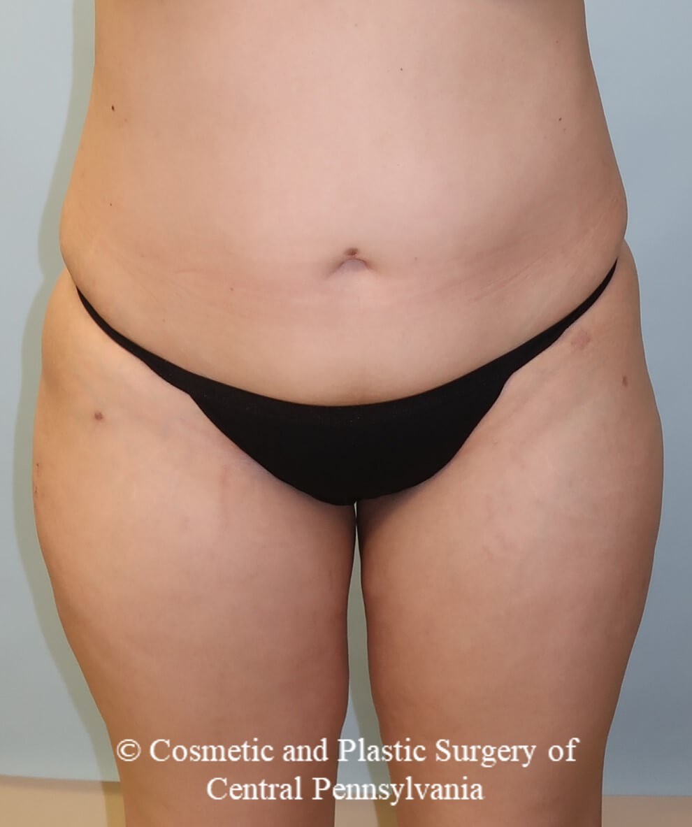 Brazilian Butt Lift After