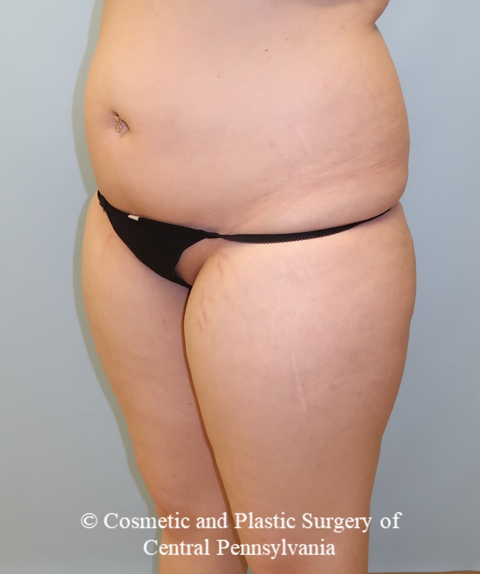 Brazilian Butt Lift Before