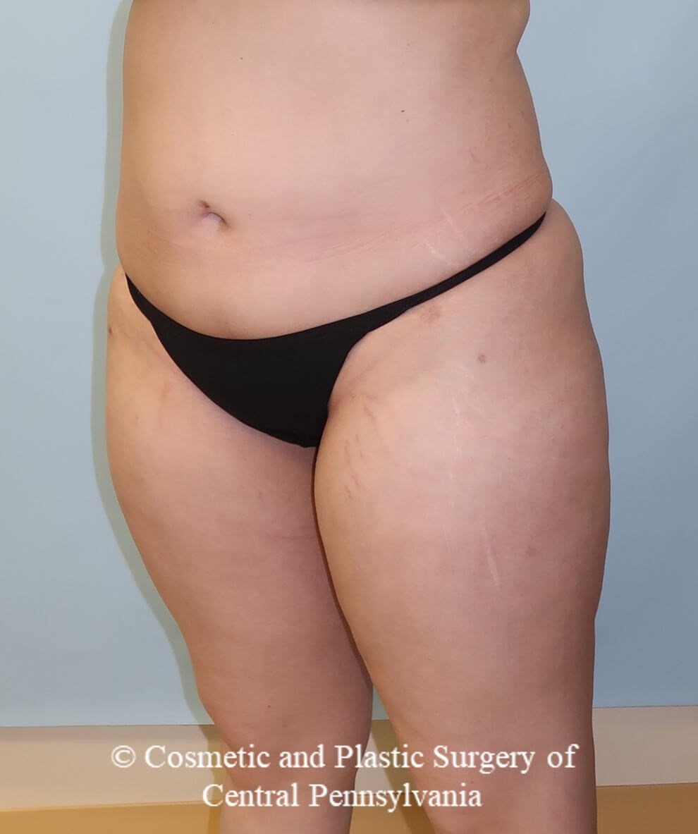 Brazilian Butt Lift After