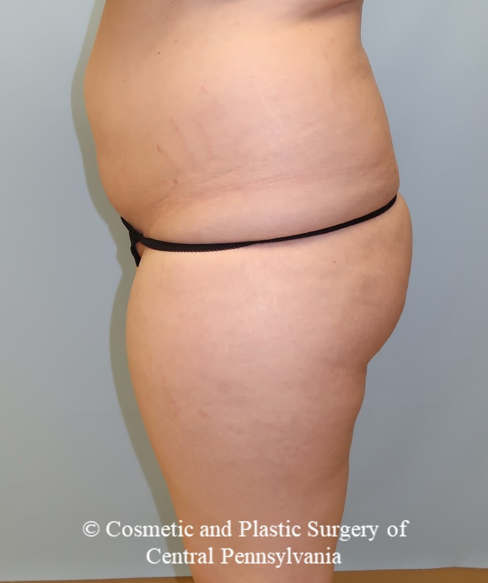 Brazilian Butt Lift Before