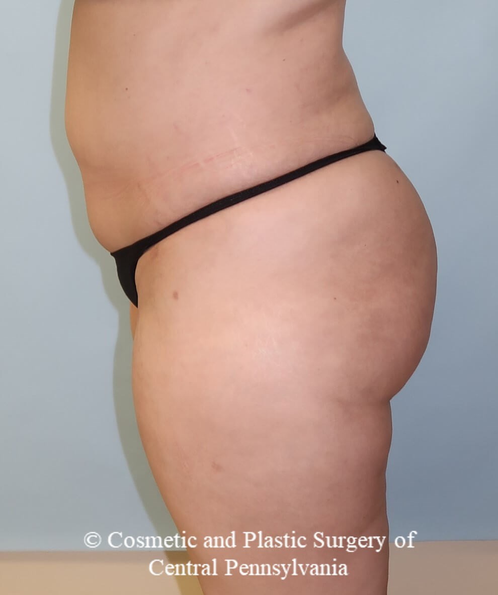 Brazilian Butt Lift After