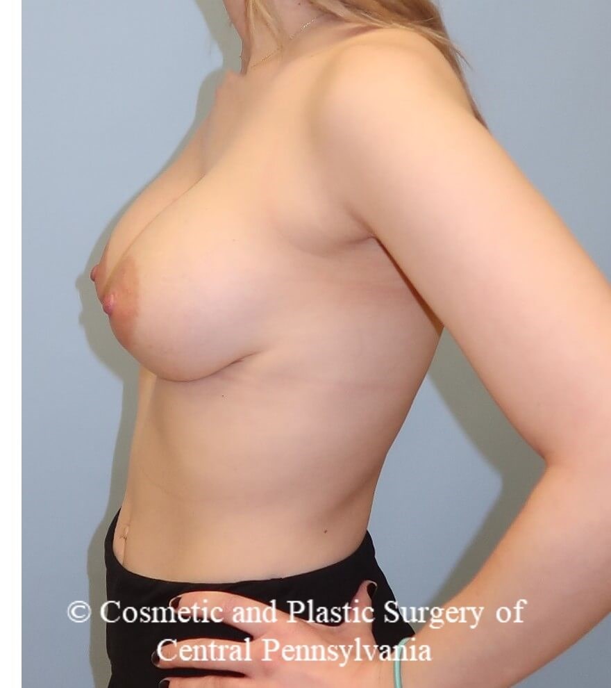 Breast Augmentation After