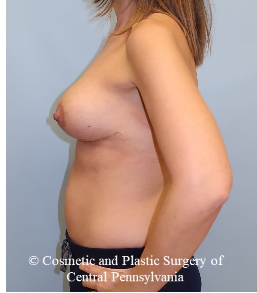 Breast Augmentation Lift After