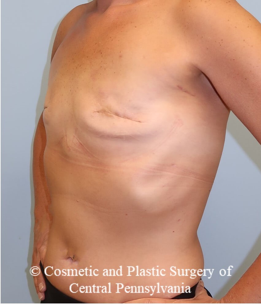 Breast Reconstruction Before