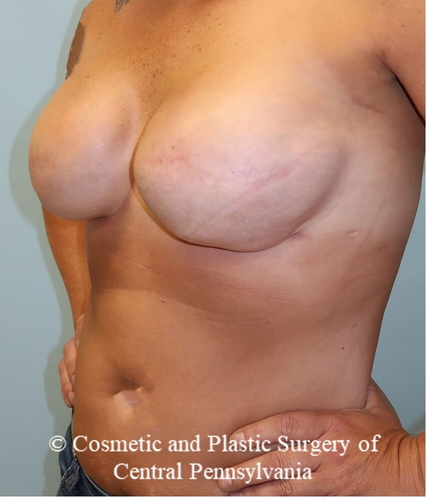 Breast Reconstruction After
