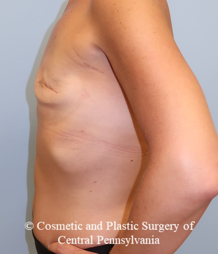 Breast Reconstruction Before