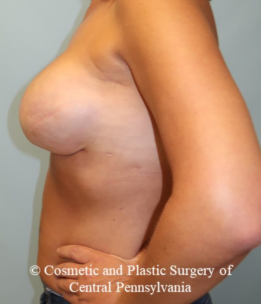 Breast Reconstruction After