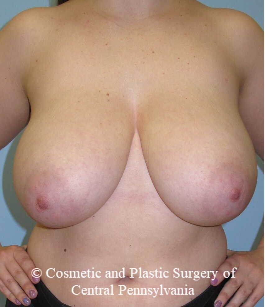Breast Reduction Before