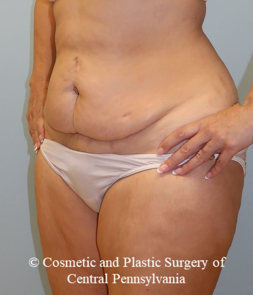 Tummy Tuck Before