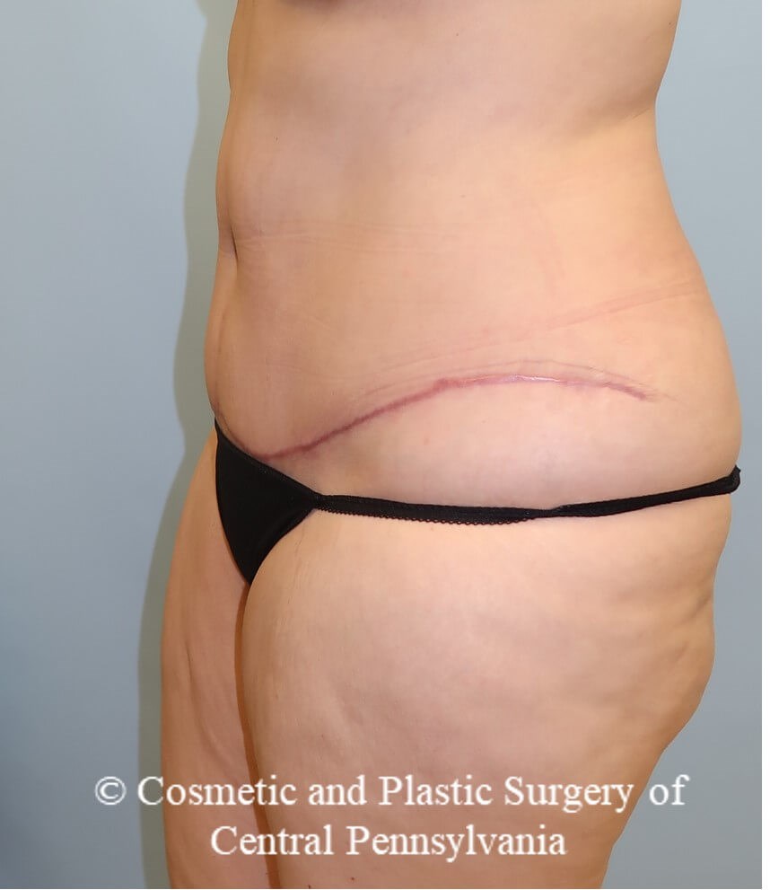 Tummy Tuck After