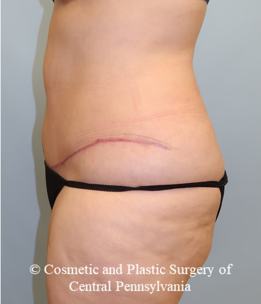 Tummy Tuck After