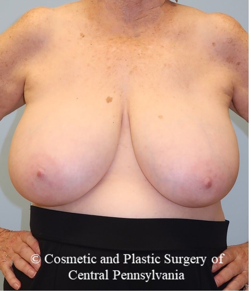 Breast Reduction Before