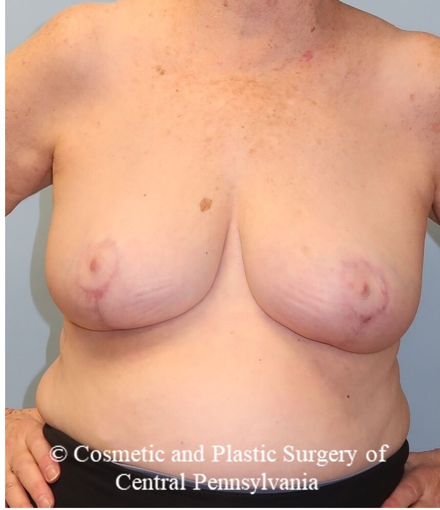 Breast Reduction After
