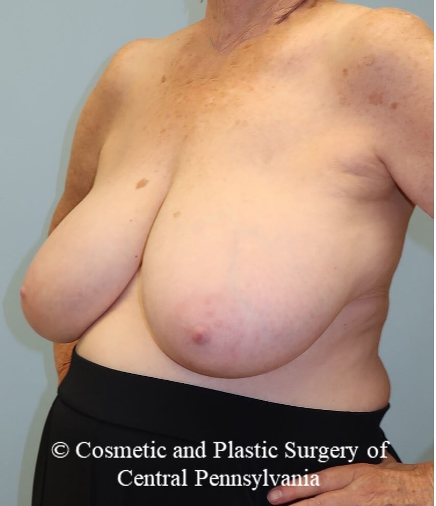 Breast Reduction Before