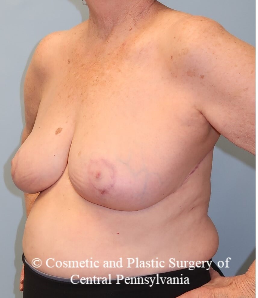 Breast Reduction After