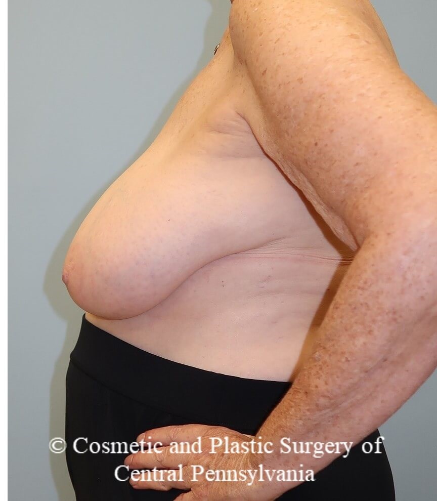 Breast Reduction Before