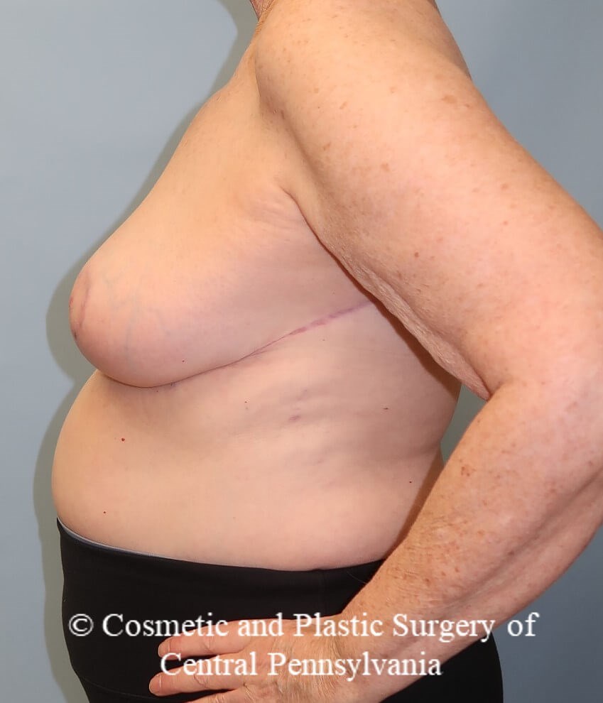 Breast Reduction After