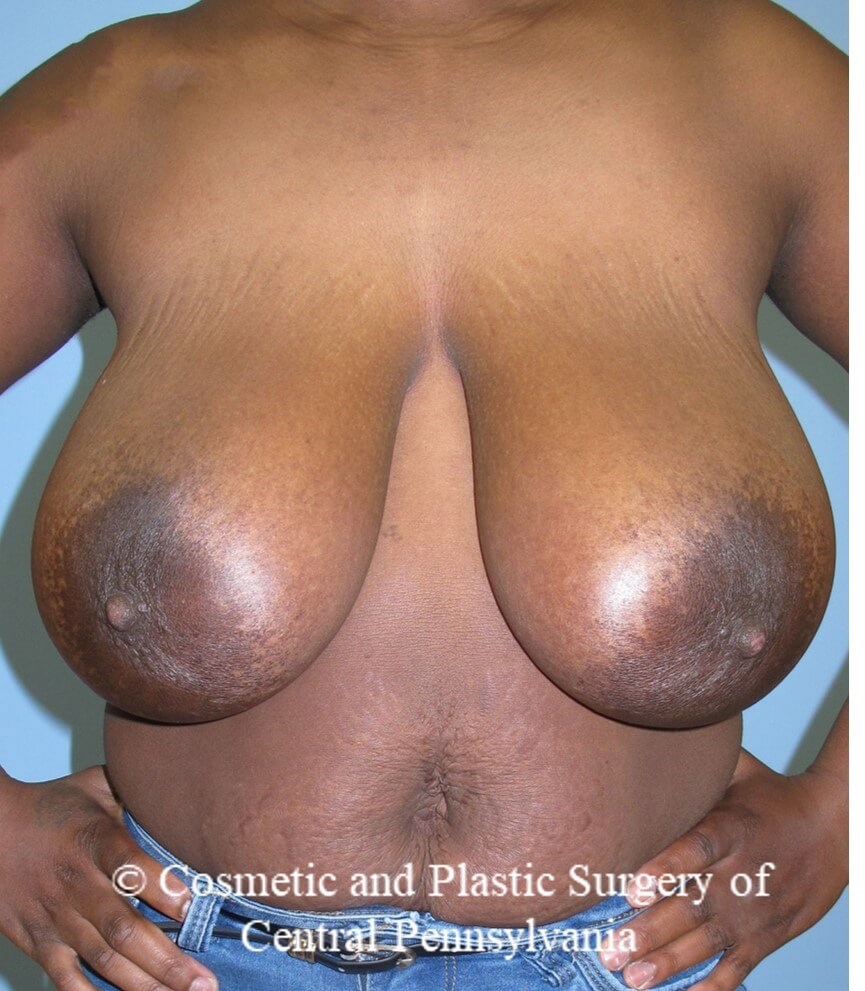 Breast Reduction Before