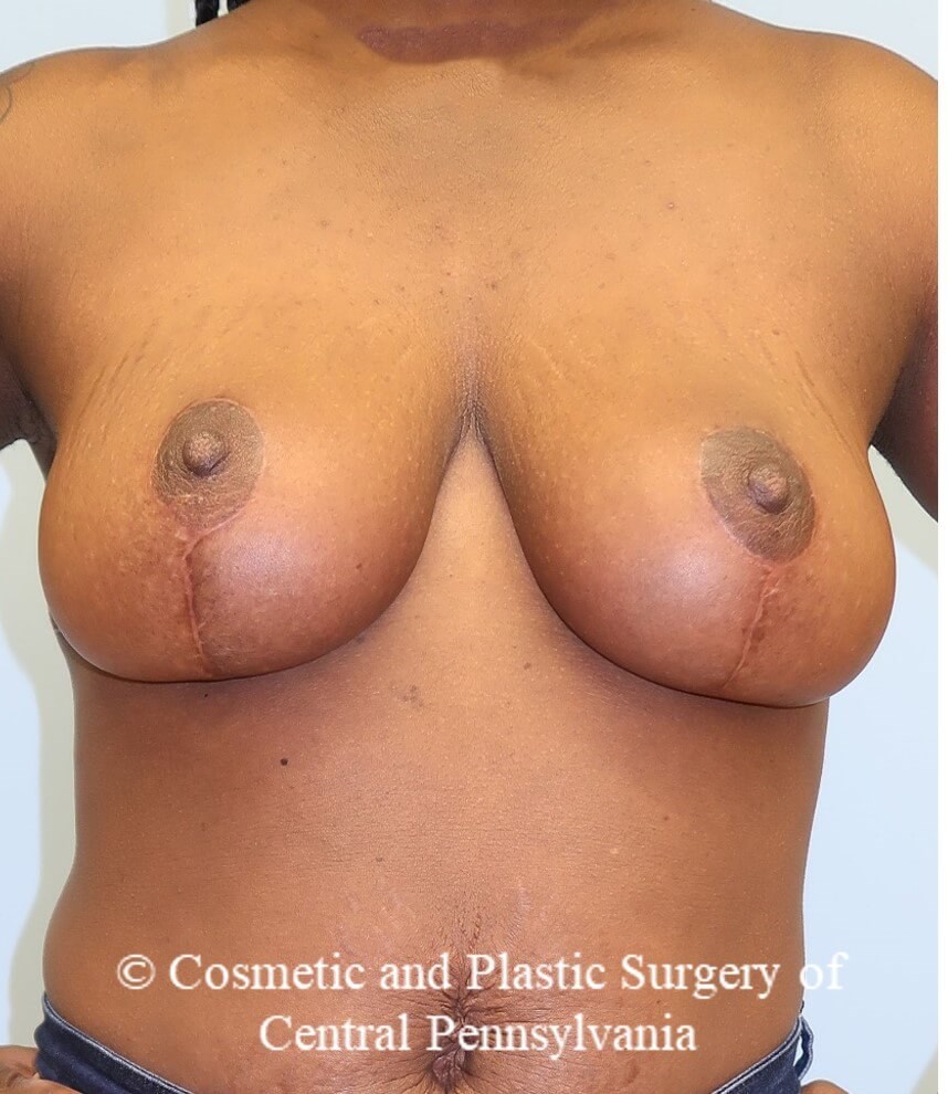 Breast Reduction After