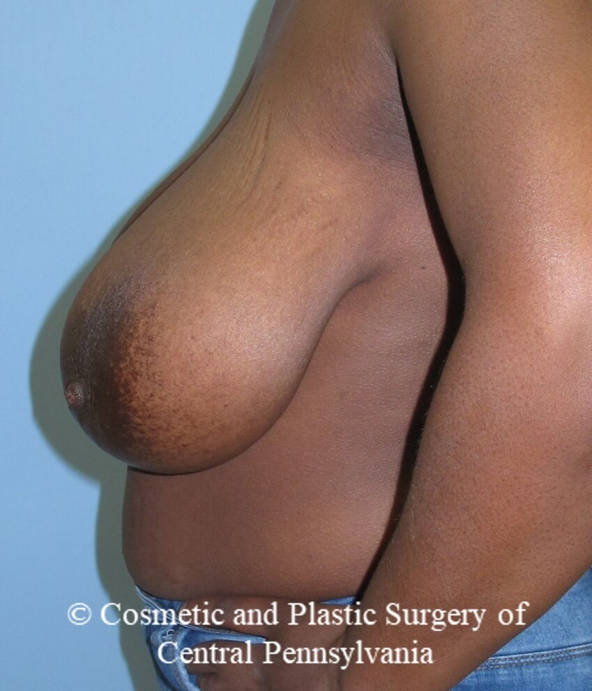Breast Reduction Before