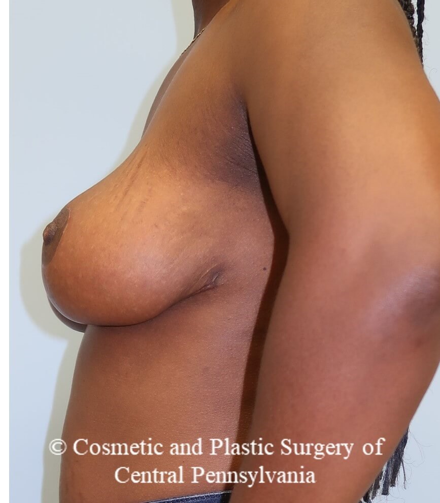 Breast Reduction After