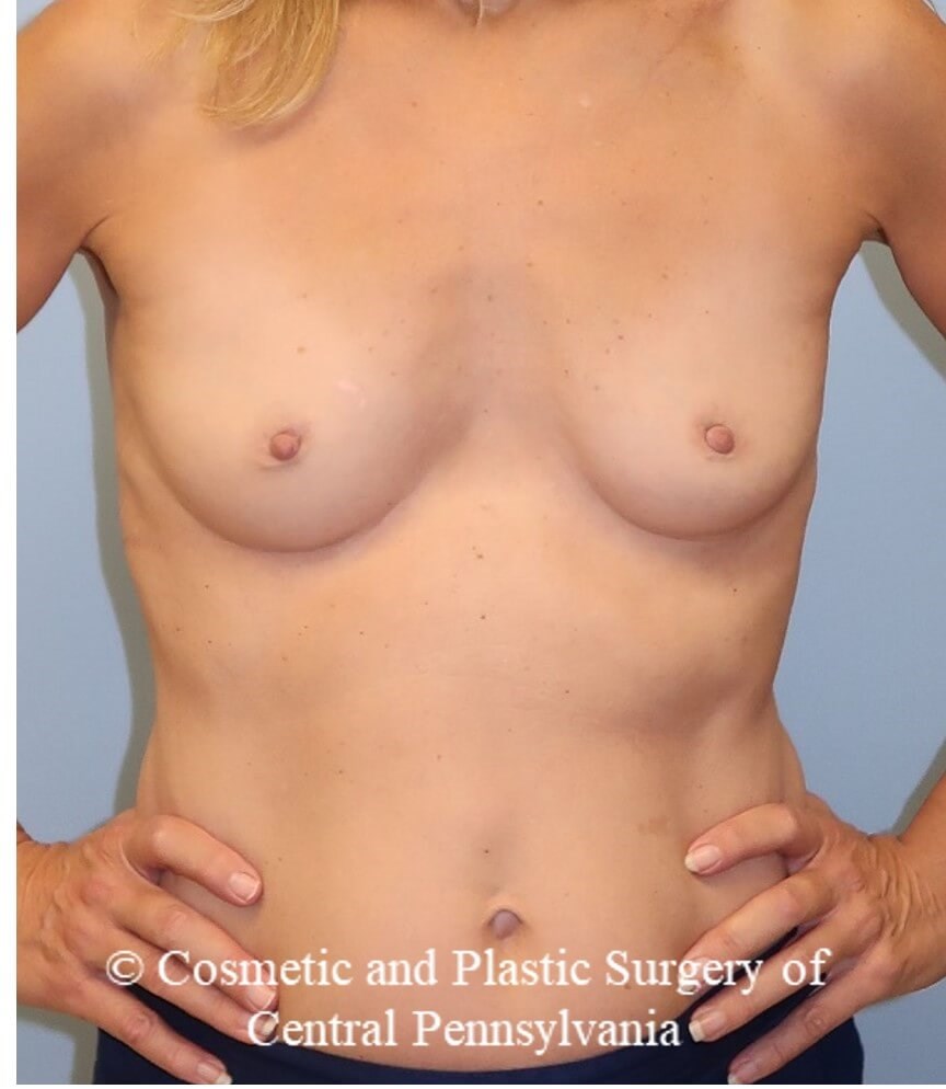 Breast Augmentation Before