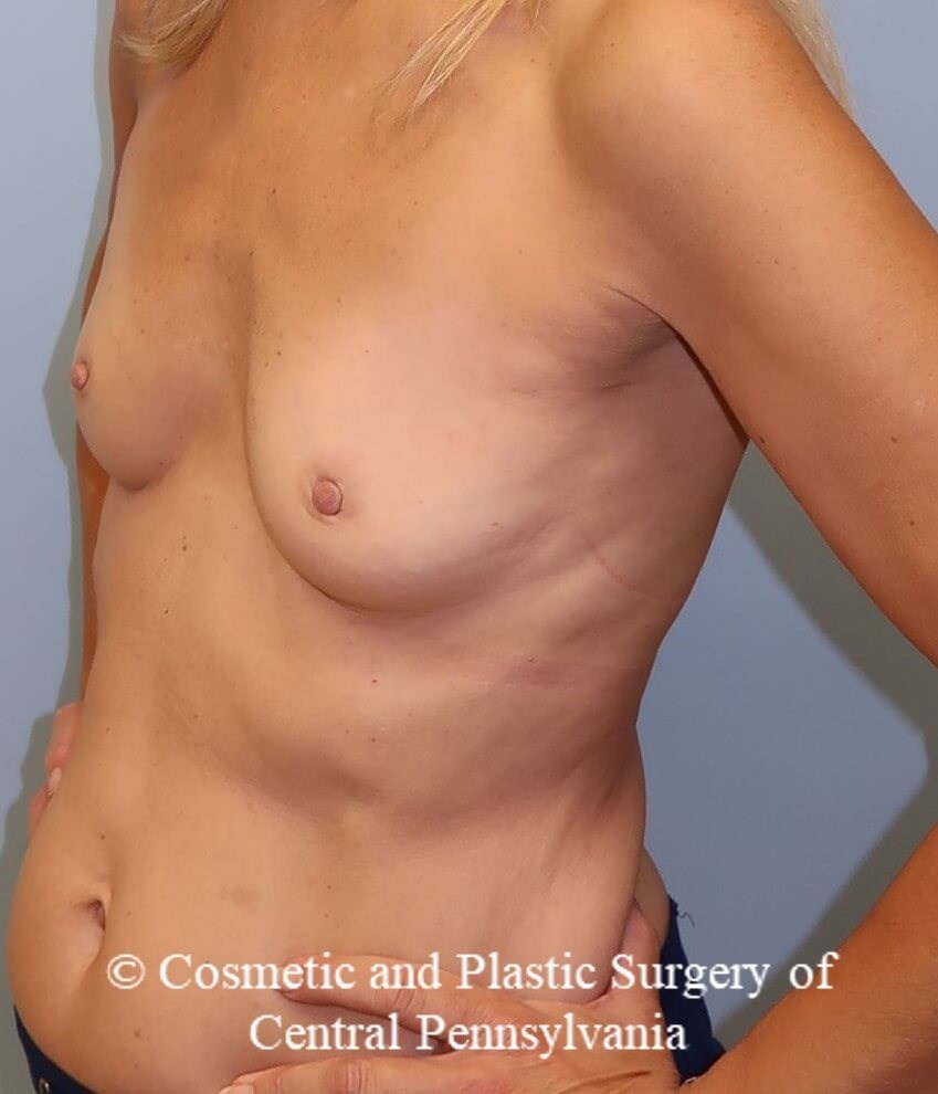Breast Augmentation Before