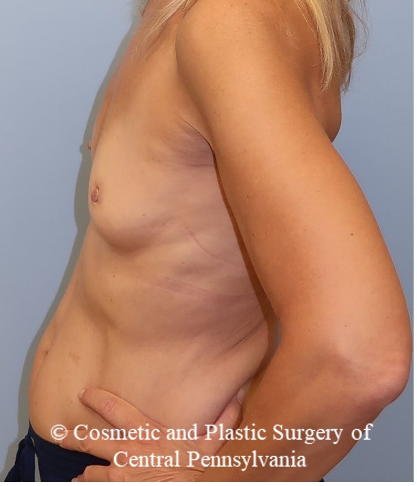 Breast Augmentation Before