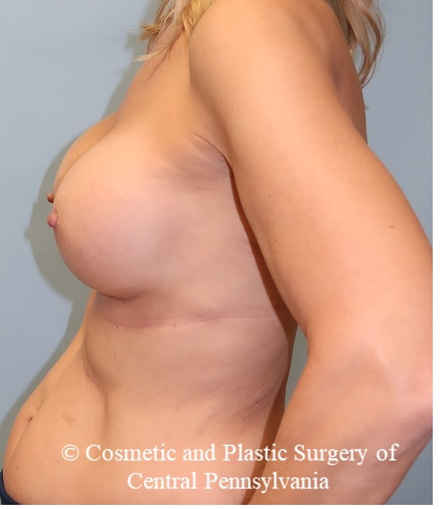 Breast Augmentation After