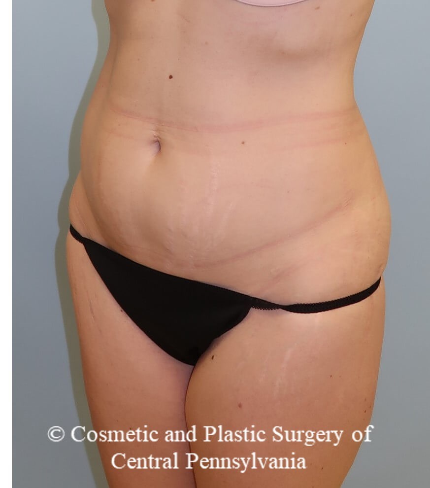 circumferential body lift Before