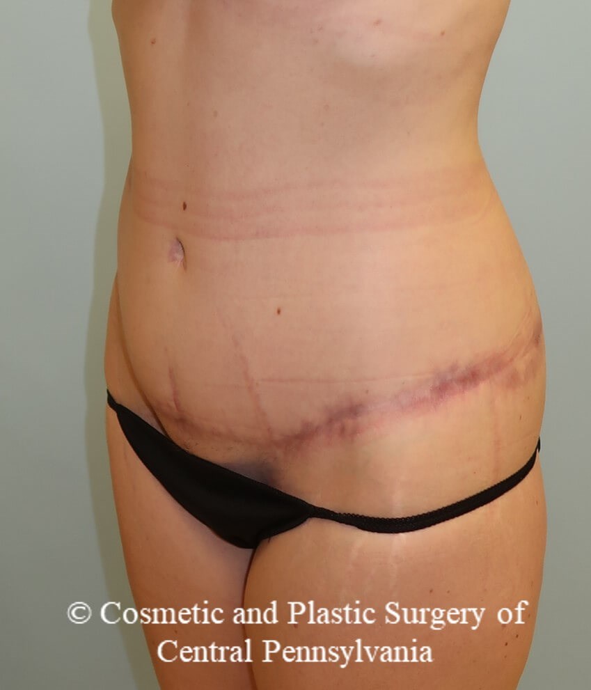 circumferential body lift After