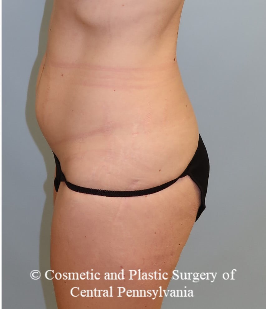 circumferential body lift Before