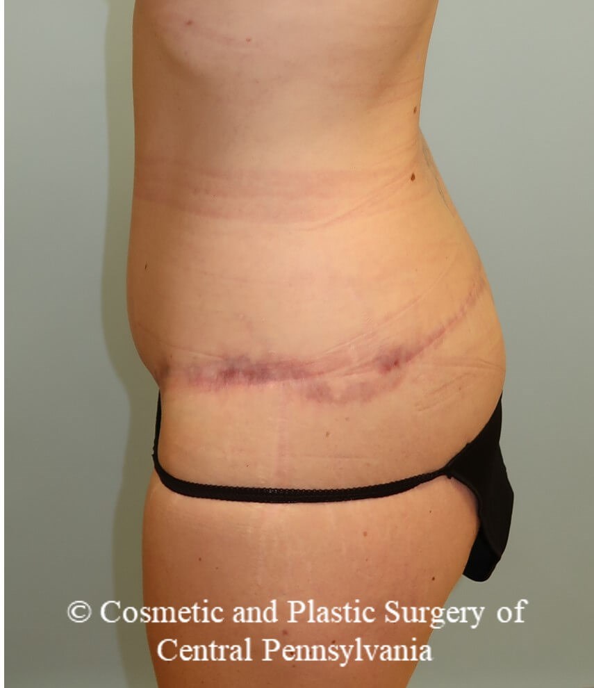 circumferential body lift After