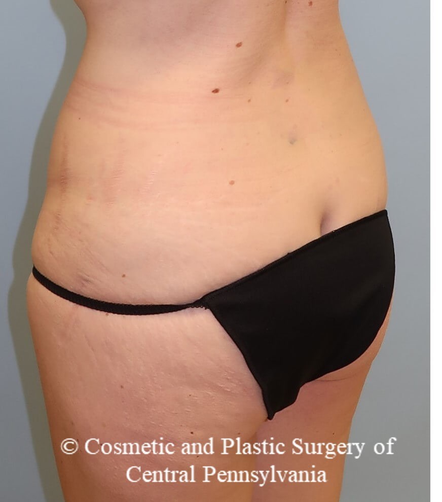 circumferential body lift Before