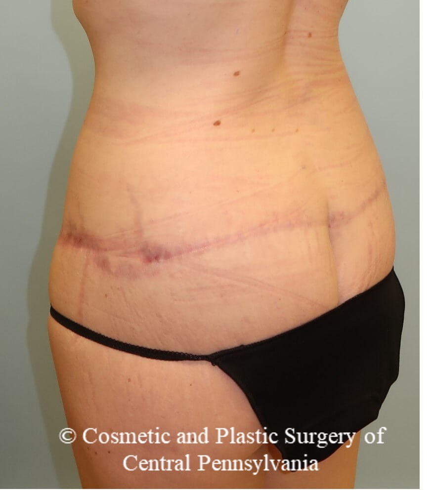 circumferential body lift After