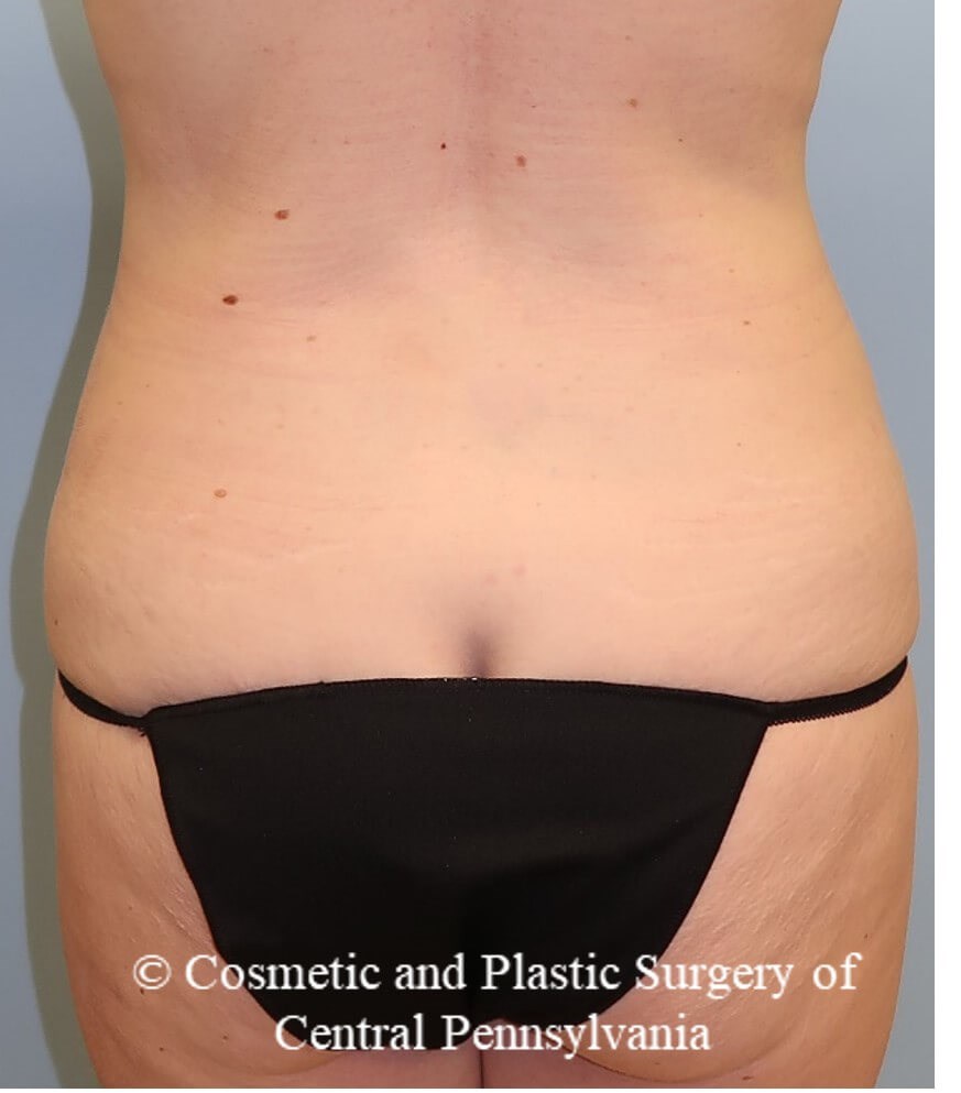 circumferential body lift Before