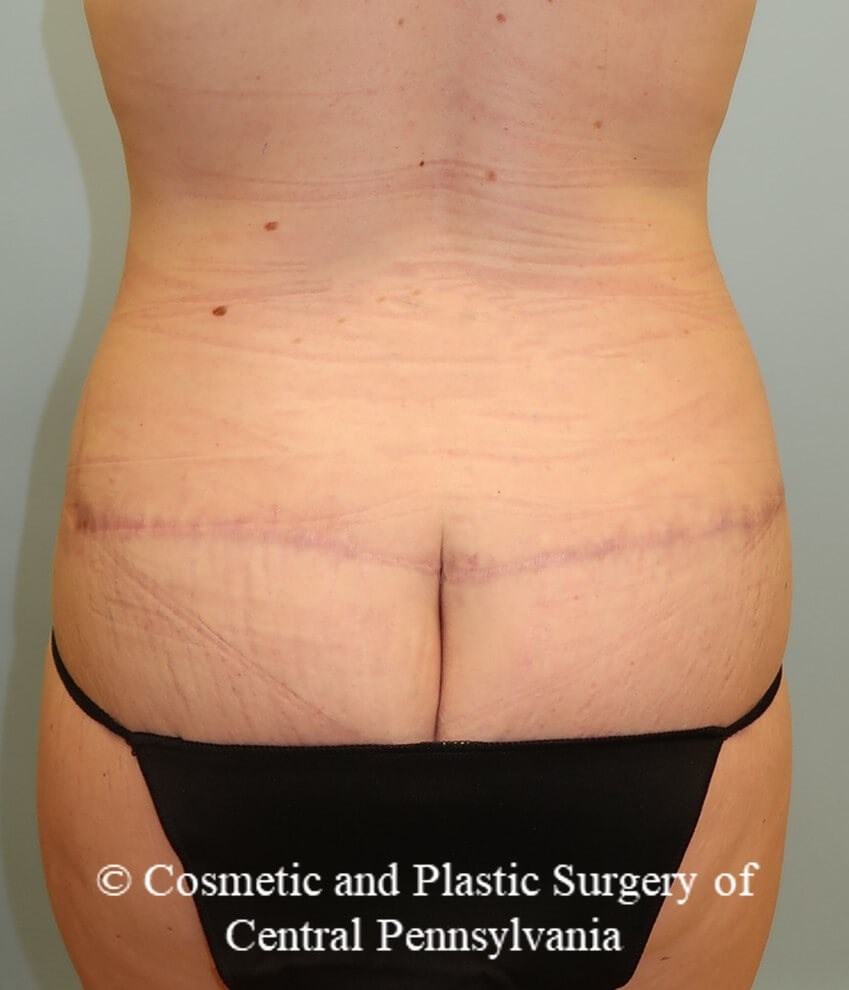 circumferential body lift After
