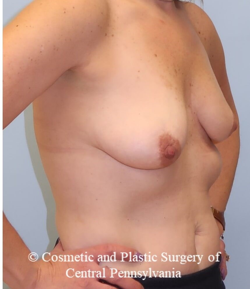 Breast Reconstruction Before