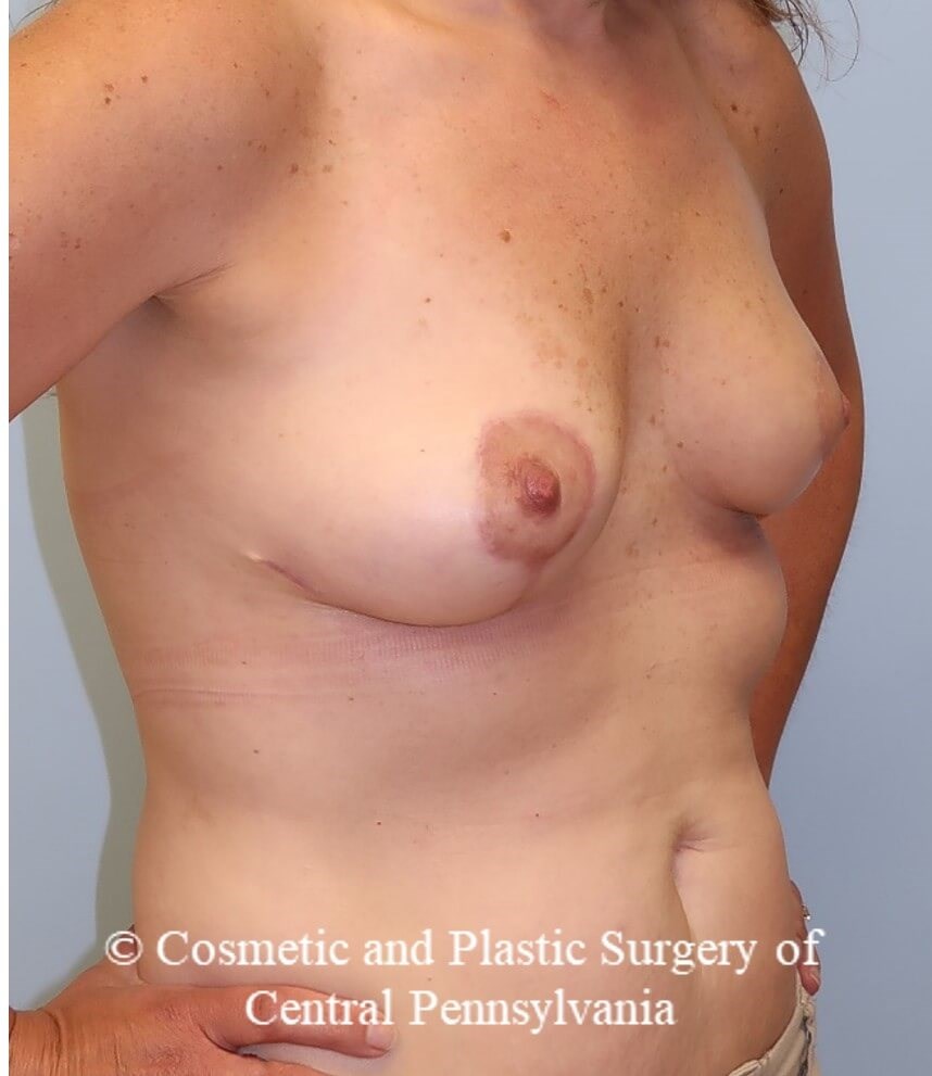 Breast Reconstruction After