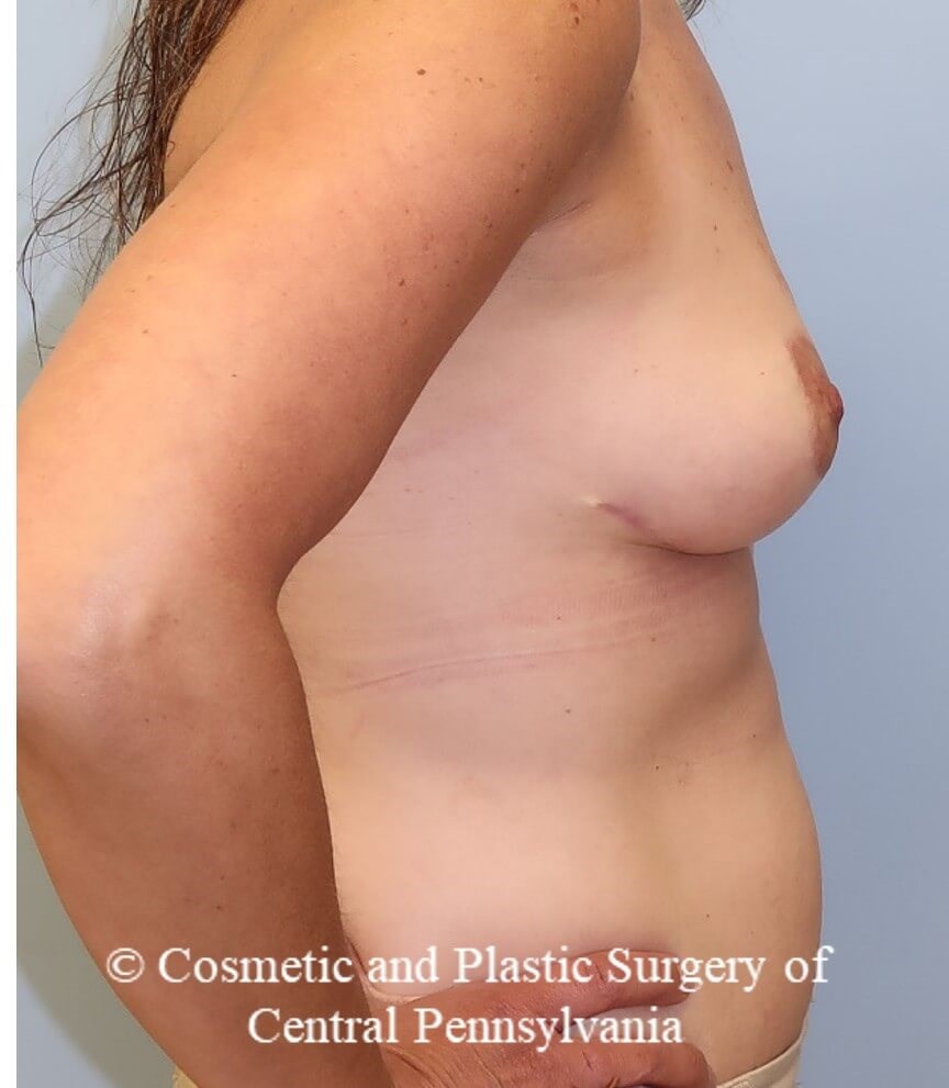 Breast Reconstruction After