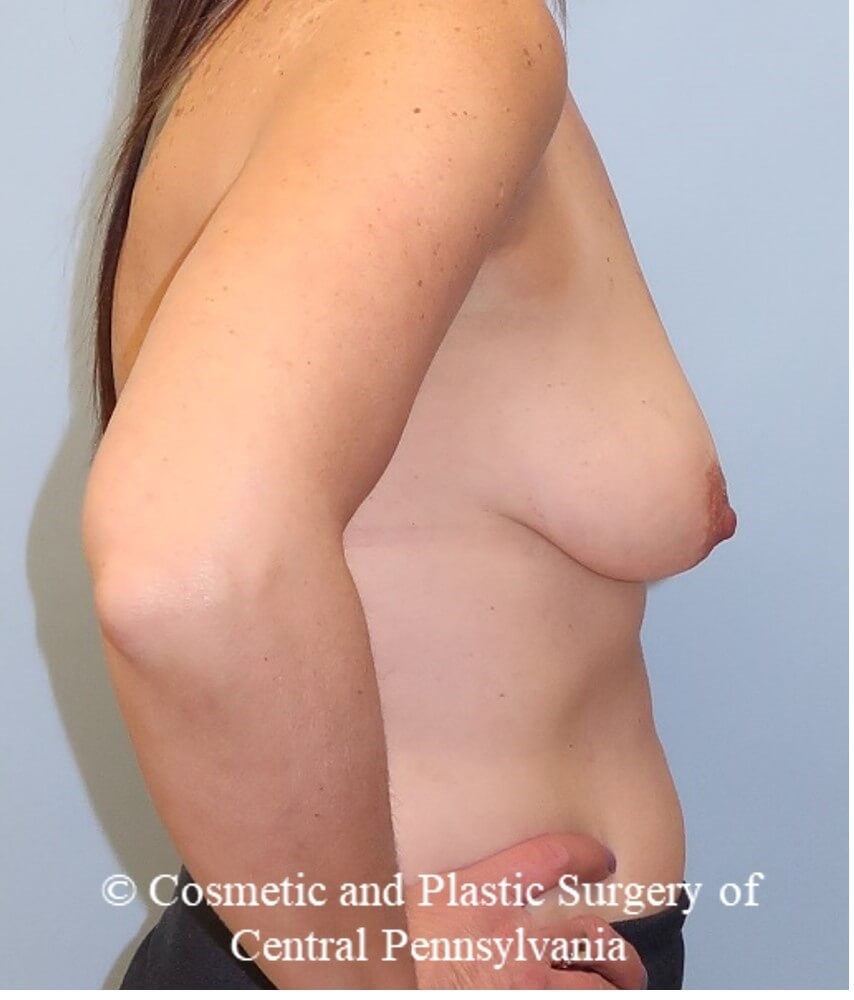 Breast Reconstruction Before