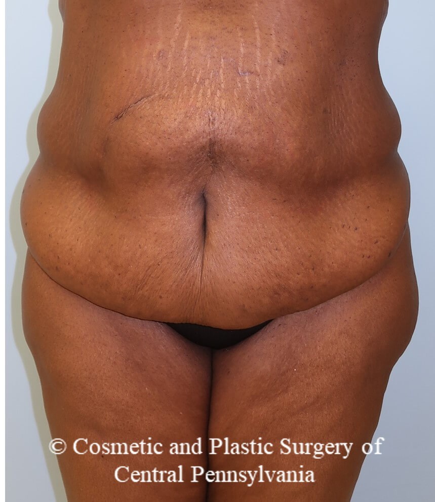 Tummy Tuck Before