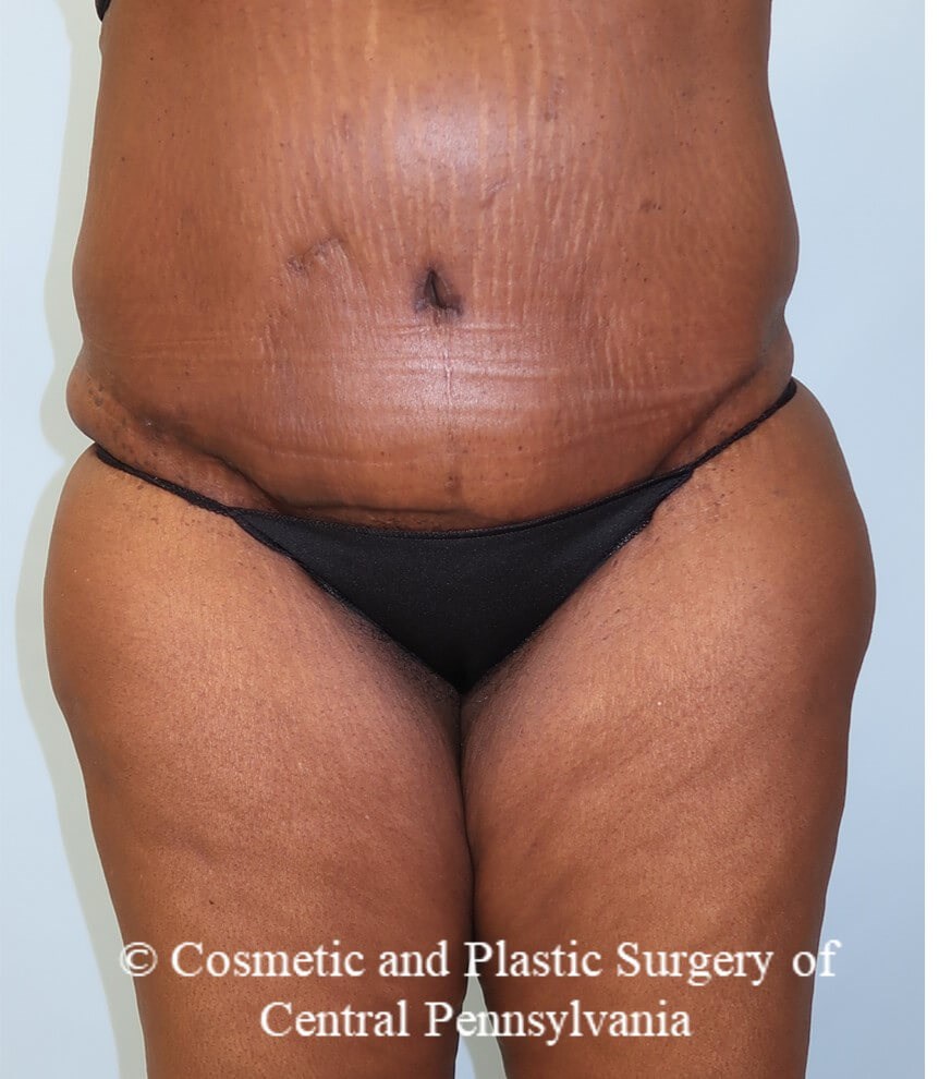 Tummy Tuck After