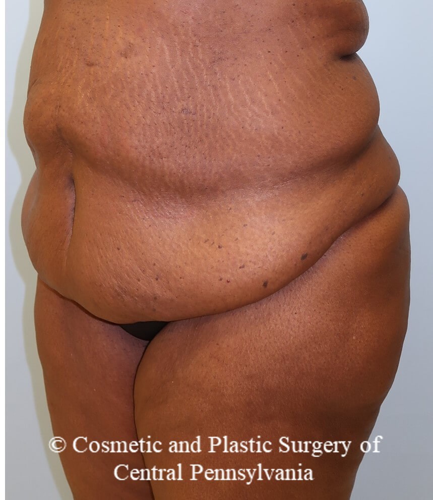 Tummy Tuck Before