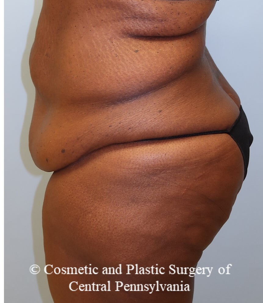 Tummy Tuck Before